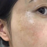 利奕菲醫用祛斑霜老年斑專(zhuān)用非藥一夜消去斑黃褐斑雀斑曬斑男女士用的藥 1盒裝【日本監制】祛斑特效果最好的產(chǎn)品 強力祛除手部臉部官方正品美白祛斑霜鹽酸極速消斑溶液 曬單實(shí)拍圖