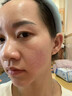 BEAUTY NOTES壬二酸凝膠20%祛痘藥膏淡化痘印痘坑修復男士水楊酸消炎痤瘡專(zhuān)用 曬單實(shí)拍圖