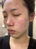維特絲水楊酸祛痘精華淡化痘印去痘痘收毛孔男女士護膚品青春期學(xué)生專(zhuān)用 曬單實(shí)拍圖