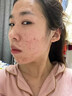 BEAUTY NOTES壬二酸凝膠20%祛痘藥膏淡化痘印痘坑修復男士水楊酸消炎痤瘡專(zhuān)用 曬單實(shí)拍圖
