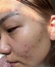 儒意（RUYI）壬二酸祛痘藥膏凝膠態(tài)硫修復淡化痘印水楊酸學(xué)生青春痘痤瘡青少年 曬單實(shí)拍圖