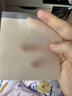 美皮護瑞典進口美皮護疤痕貼Mepiform自粘軟聚硅酮瘢醫用美容膠帶美膚貼 瑞典本土版10x18cm簡包裝*1片裝 曬單實拍圖
