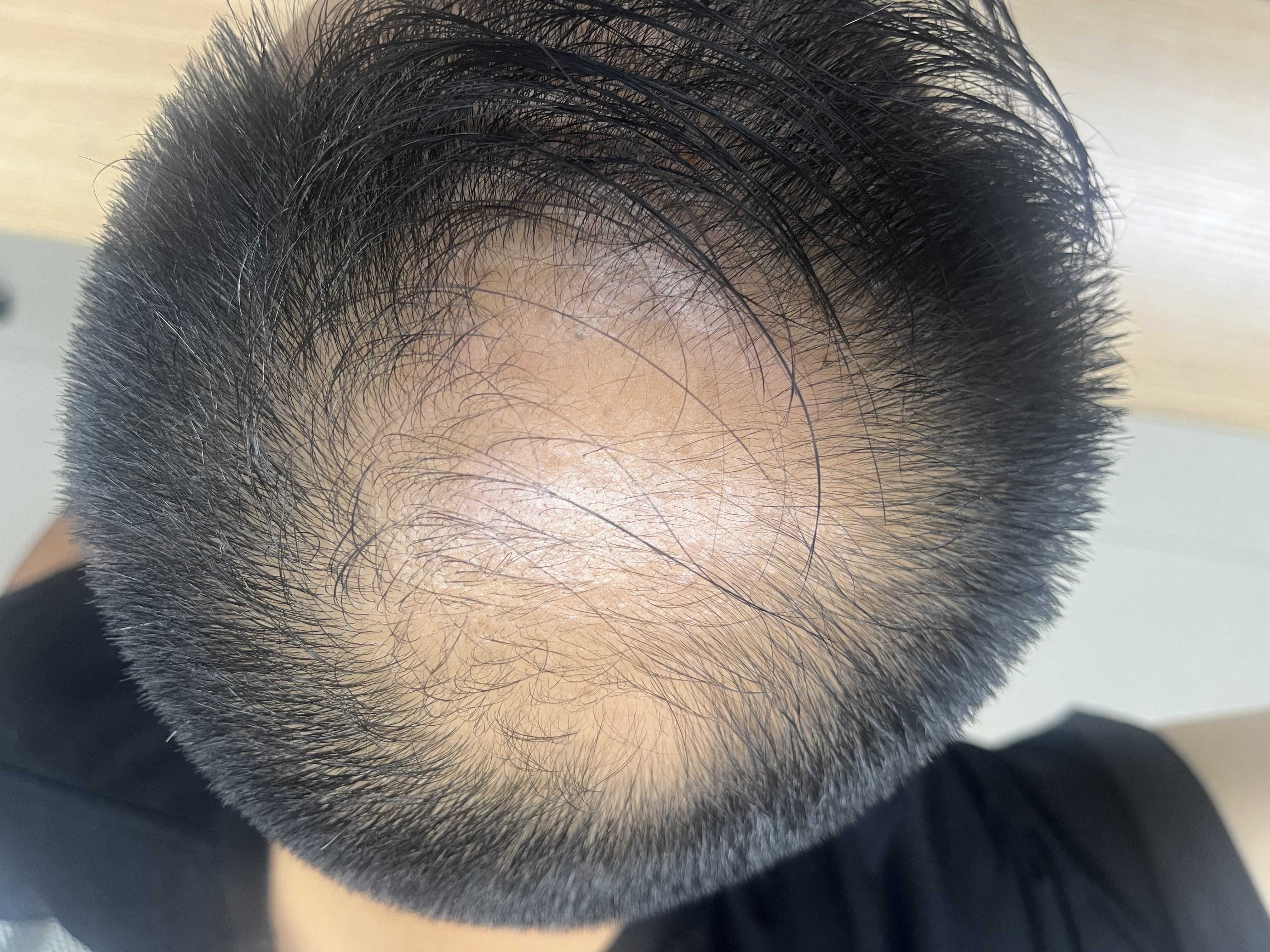蔓迪【第二代米諾地爾】蔓迪5%米諾地爾泡沫劑60g/3瓶/盒生發液防脫洗發水用于治療脫發和斑禿 曬單實拍圖