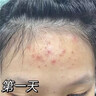 BEAI水楊酸祛痘面膜20片男女士收縮毛孔淡化痘印閉口粉刺補(bǔ)水去黑頭 曬單實(shí)拍圖