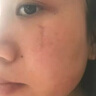 莘護疤痕修復凝膠成人醫用硅酮透明質(zhì)酸凝膠疤痕膏疤痕輔助改善預防醫用疤痕凝膠15g 曬單實(shí)拍圖