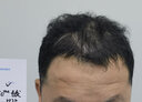 雍禾植發(fā)[主任團(tuán)隊(duì)] 適用發(fā)際線種植、頭頂加密、發(fā)縫種植、藝術(shù)植發(fā)等 剃發(fā)植發(fā)2000單位及以內(nèi)（一口價(jià)） 曬單實(shí)拍圖