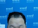 雍禾植發(fā)[主任團(tuán)隊(duì)] 適用發(fā)際線種植、頭頂加密、發(fā)縫種植、藝術(shù)植發(fā)等 剃發(fā)植發(fā)2000單位及以內(nèi)（一口價(jià)） 曬單實(shí)拍圖