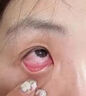 色甘酸鈉滴眼液兒童眼睛過(guò)敏發(fā)癢眼藥水過(guò)敏眼藥水止的癢眼睛干澀過(guò)敏性結膜炎抗過(guò)敏眼藥水眼睛越揉越癢 1盒 曬單實(shí)拍圖