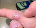日本原裝進(jìn)口扁平疣軟膏 扁平疣面部臉部去除眼部頸部脖子手足部肉刺 香港直郵原裝進(jìn)口 日本扁平疣軟膏10g 1支裝 曬單實(shí)拍圖