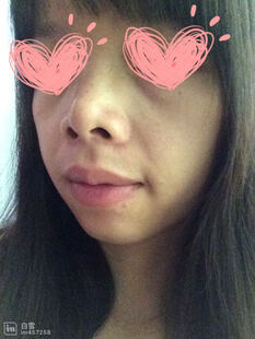 韩阁美容金水三件套装 去痣点痣膏祛斑点斑去