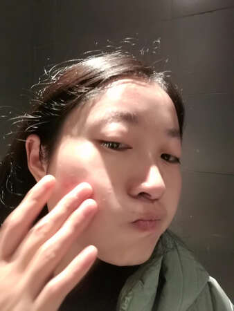 2年前长痘的时候买过这一款面膜，当时的价格还比较便宜。因为前几个月学习熬了几个夜，脸上堪称毁容了一般，一直反复不停的长痘，然后满脸都是痘印，收到面膜前脸上的痘痘还未消停过，用了大概一周了，明显发现额头上的痘痘和右边脸上的痘痘消掉了，现在就差慢慢淡化痘印了，真的希望我恢复到之前的皮肤状态。其实在这之前我用了很长一段时间的国外的高端精油，发现当时有用，可是一直完全消除不掉，这一款前几年用过，想了很久记不起来名字，突然间有一天记起来了，就马上买了，真的觉得他们家的产品对我很有帮助。希望以后越来越漂亮，越来越自信。