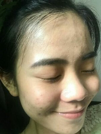 又回购了，这款面膜真心好用，补水不是一般的好，根据个人痘痘症状调配的药液，效果也真心好。三个疗程就好得差不多了，开心，
