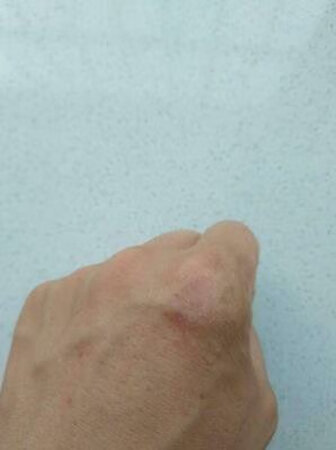 这个药膏便宜又好用，我用这个擦手足癣有很好的治疗效果，我才搽第一天过了10分钟左右就觉得涂抹的地方非常舒服，第二天又擦了一下基本就不痒了，脚下长的痒痒的水泡样的东西也在好转。