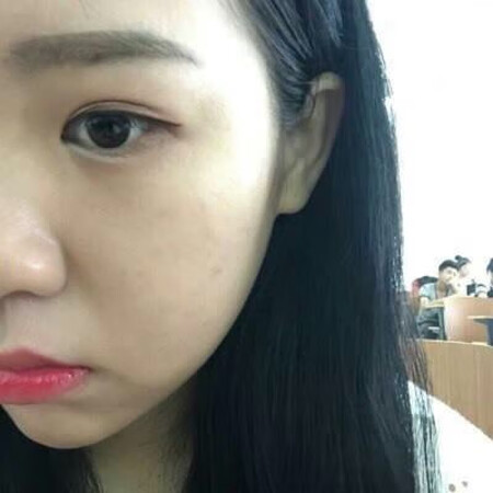 效果还是看得出来的，这个真是需要耐心坚持使用，每天我都擦三次，每次用药之前都会用温水清洗疤痕处，建议大家最好每次间隔六个小时以上可能效果更好，我就是这样使用的，在使用一段时间疤痕应该就消失了的