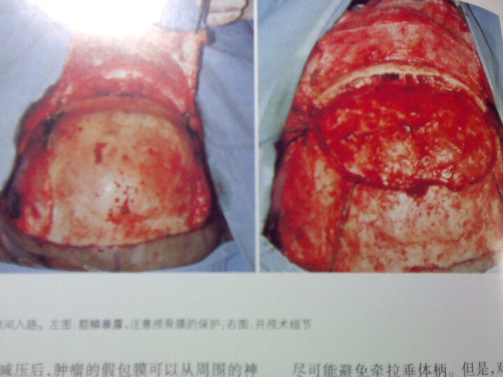 神经外科手术技术图谱--超经典的神经外科手术
