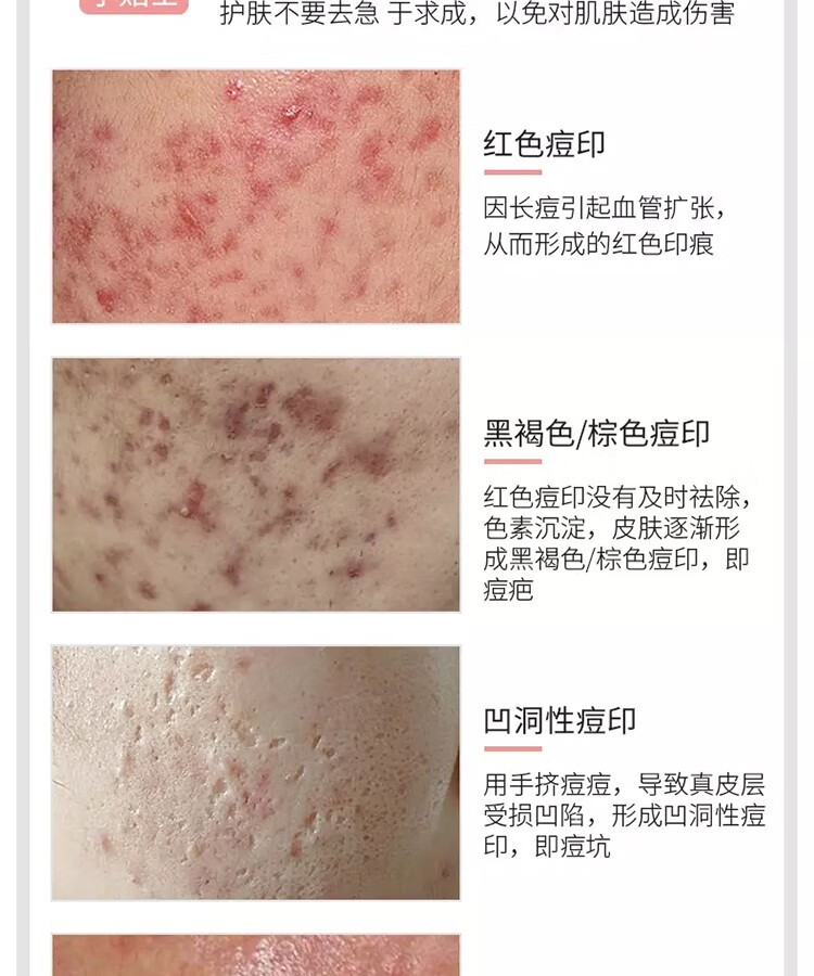 南京同仁堂祛痘膏芦荟祛痘凝胶收缩毛孔闭口粉刺淡化痘印痘肌男女青春痘20g