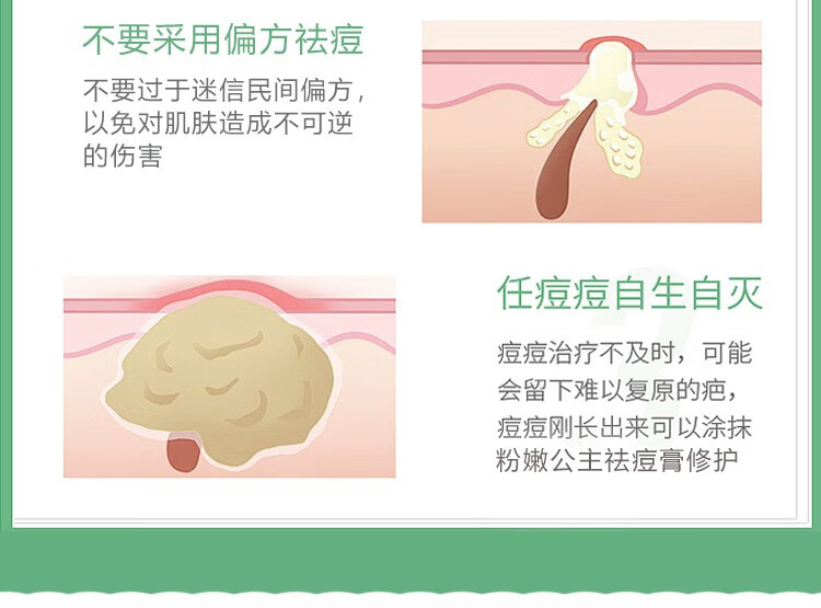 NHFOUYOU祛痘膏祛痘印修复淡化痘印痘坑青春痘美攻芙美白祛印修护乳液 1瓶【轻度痘痘】