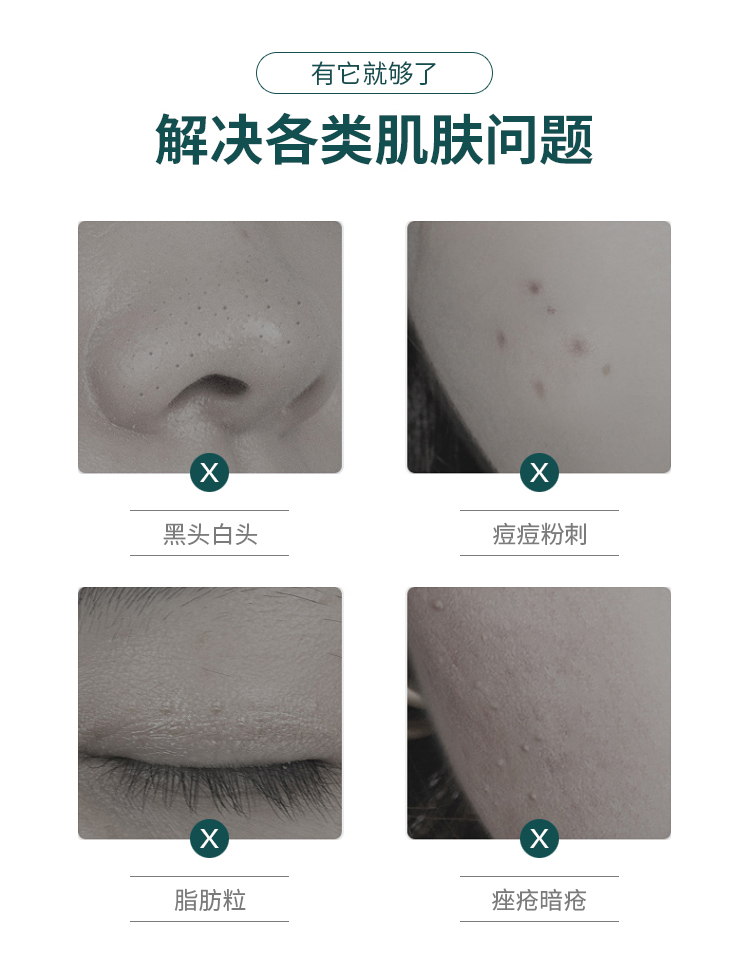 优家UPLUS 不锈钢5号细胞夹超尖粉刺针粉刺夹镊子盒装含酒精棉 黑头夹