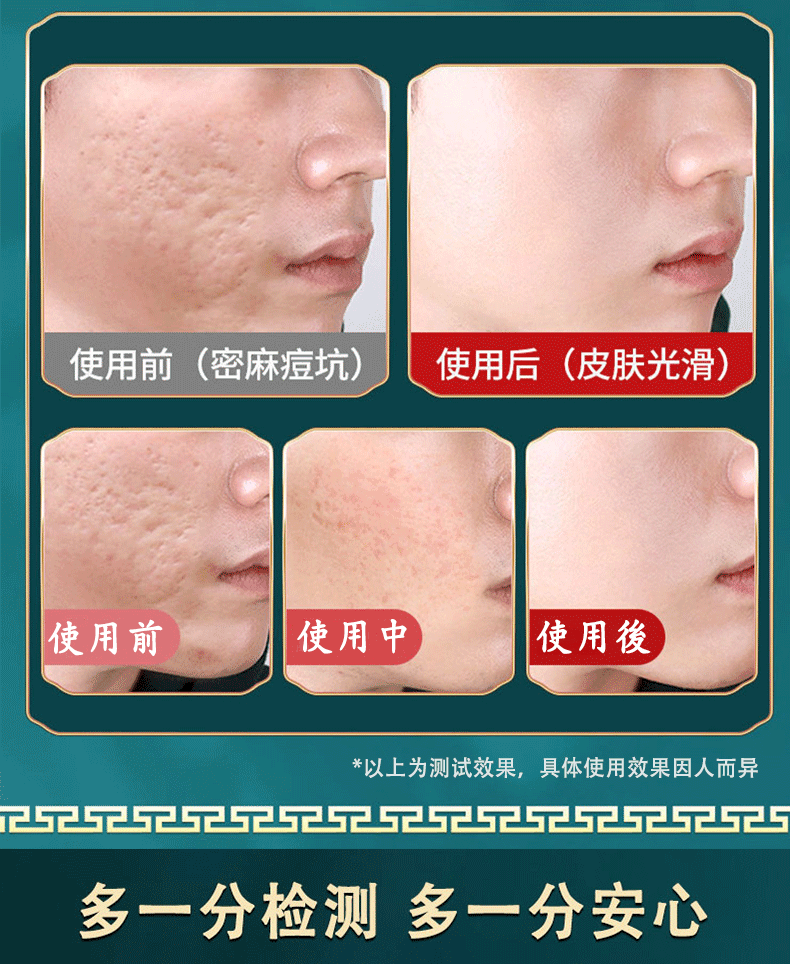 南京同仁堂祛痘膏淡化痘印痘疤痘坑呵护痘肌青春痘