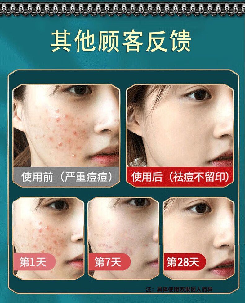 同仁堂祛痘膏去痘疤淡化痘印痘坑修复呵护痘肌亮肤舒缓青春痘20g