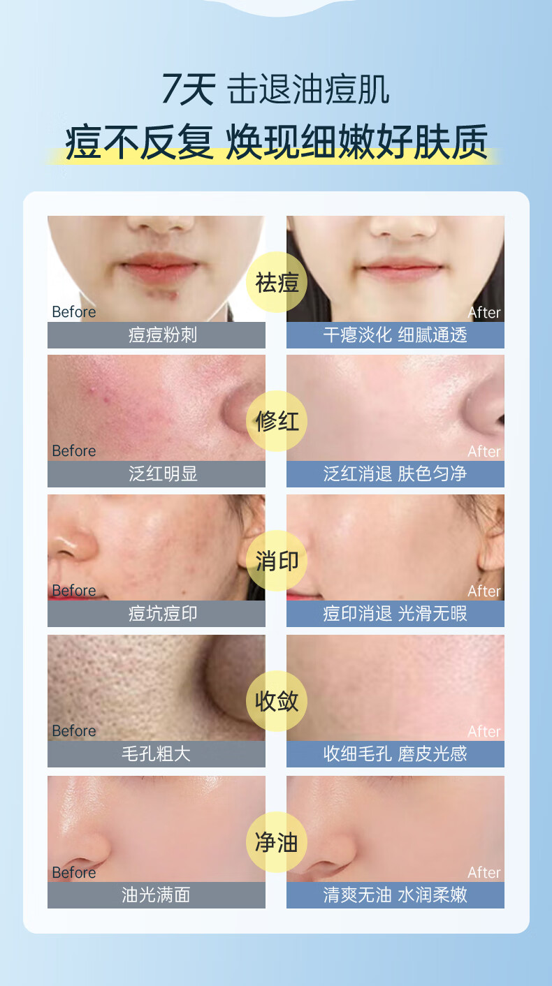 OHBT水杨酸精华液改善黑头闭口细致毛孔焕白靓白补水保湿淡化细纹呵护 【镇静舒缓】祛痘精华液50ml*2