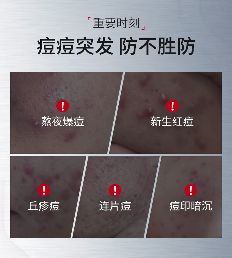 ning新加坡进口祛痘凝露淡化痘印修护痘痘红肿痘疤痘坑收缩毛孔芦荟胶
