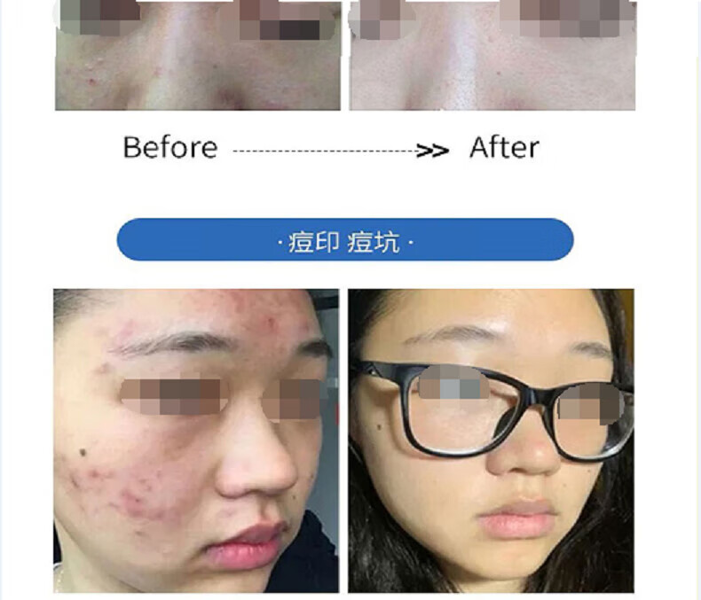 广药白云山氨基酸洗面奶痘痘黑头粉刺控油收缩毛孔深层清洁500ml