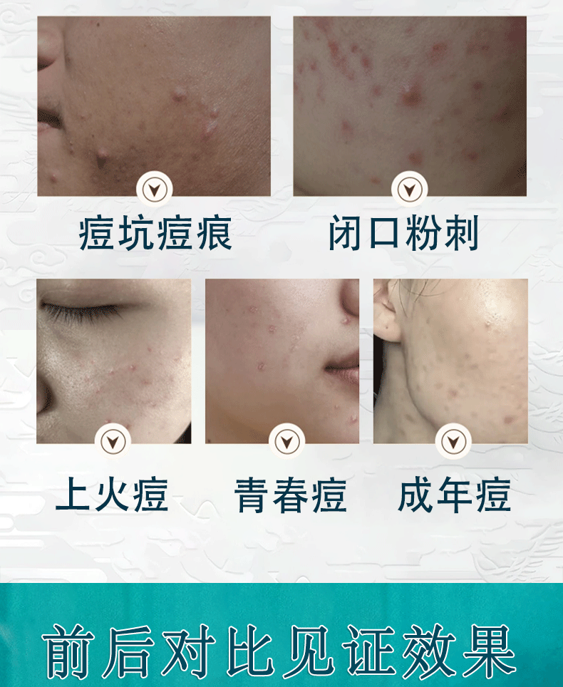 南京同仁堂祛痘膏痘疤痘坑痘痘肌呵护青春红肿痘闭口粉刺芦荟胶30g