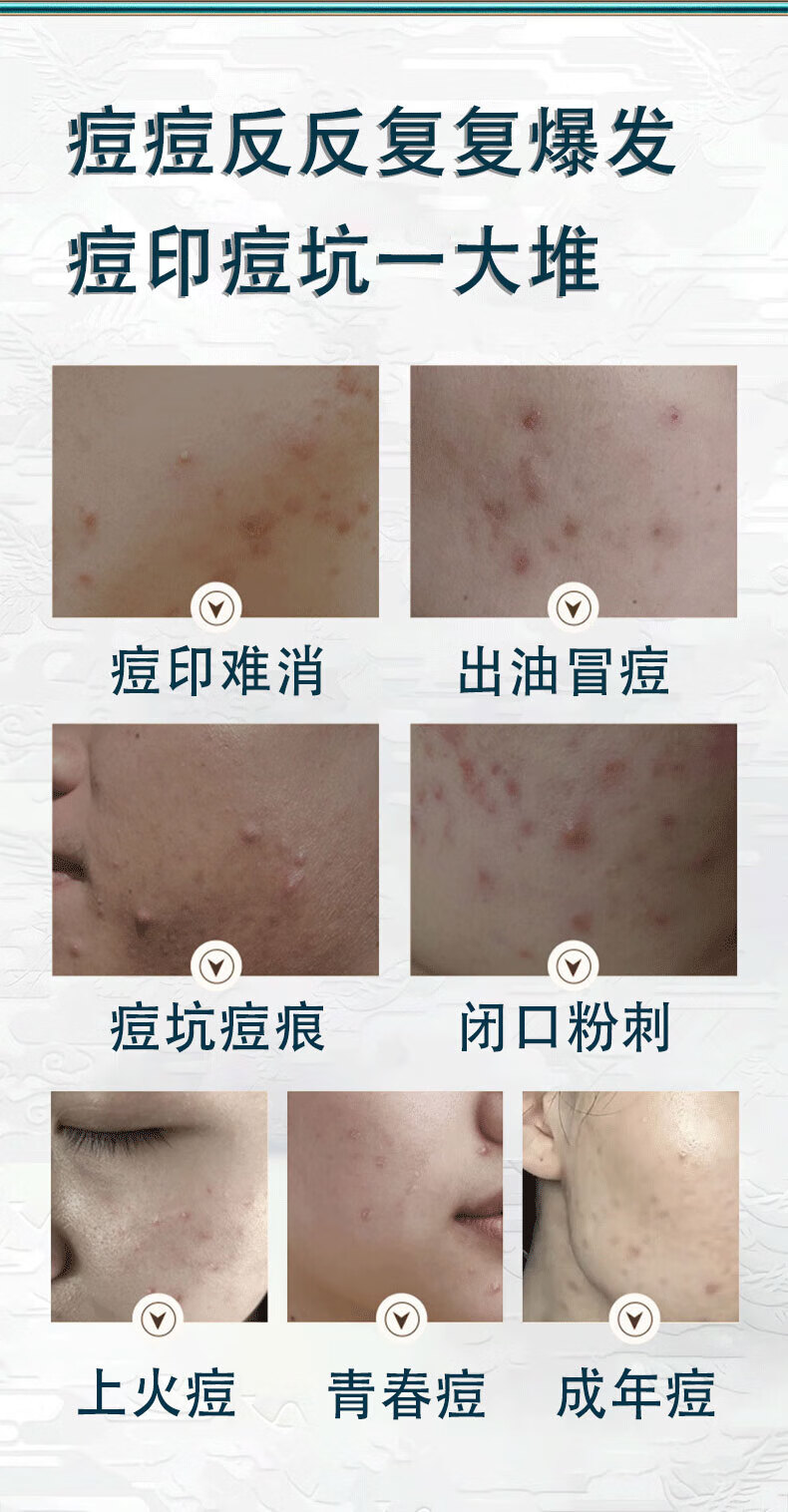 同仁堂祛痘膏去痘疤淡化痘印痘坑修复呵护痘肌亮肤舒缓青春痘20g