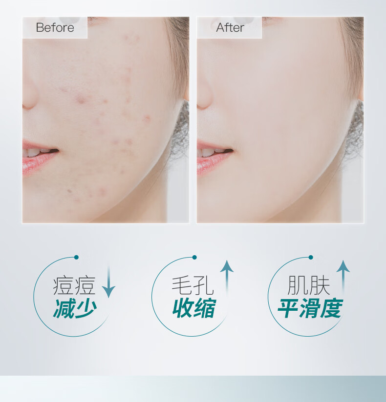 MOZOV祛痘精华液去痘痘和痘印修复痘坑闭口粉刺壬二酸水杨酸精华10支装