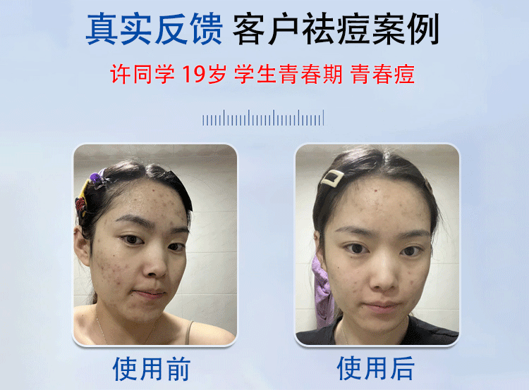 草萨草本祛痘膏消痘印清痘膏淡化痘印男士去痘疤痘坑修复学生青春痘
