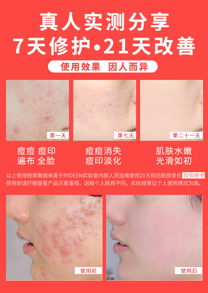 RYDEEN 壬二酸祛痘膏水杨酸净痘膏平衡痘肌痘坑熬夜助手学生党平价 三支装