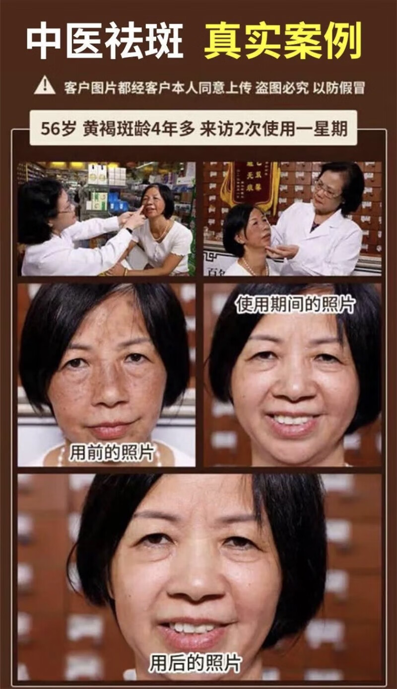 碧索娜（BISUONA）南京同仁堂美白祛斑霜去斑霜去雀斑老年斑晒斑黑斑黄褐斑妊娠斑淡化男女士面部祛斑产品30g
