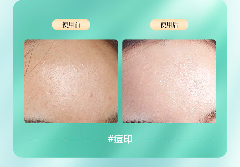  orginese南京同仁堂植物祛痘膏  淡化痘印修护霜痘坑痘疤粉刺闭口青春痘男女士净颜 30g/瓶