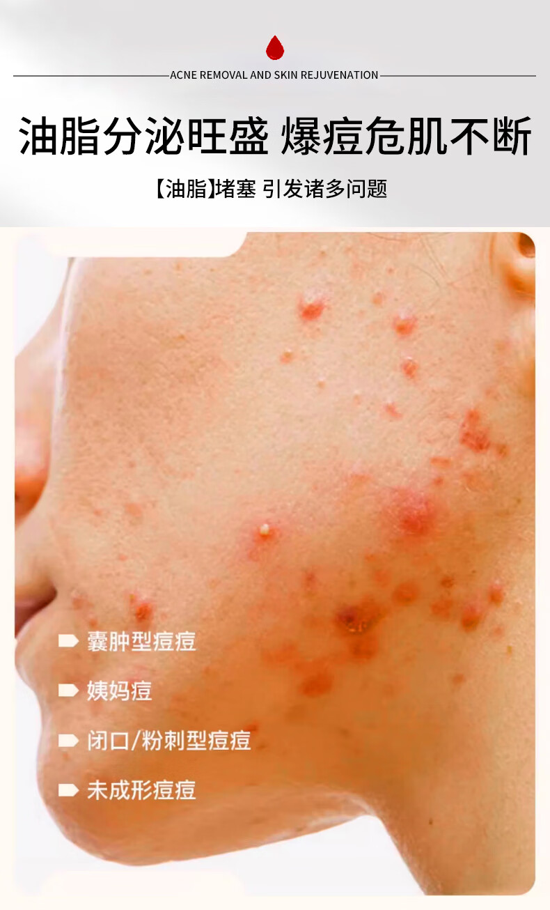 致朵祛痘霜膏修护淡化痘印痘坑去痘痘和痘痘印祛去粉刺青春痘30g/瓶