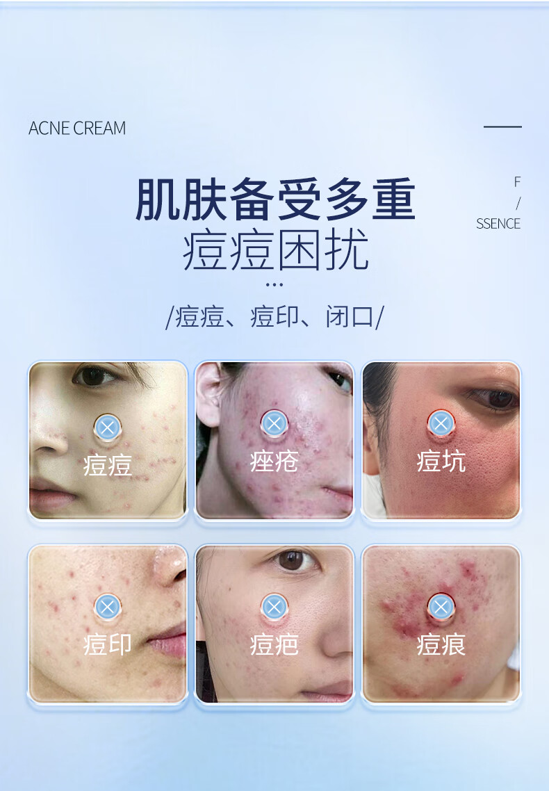 ORGINESE甘草植萃祛痘精华乳膏去闭口粉刺额头红肿痘痘姨妈痘下巴抗痘凝胶