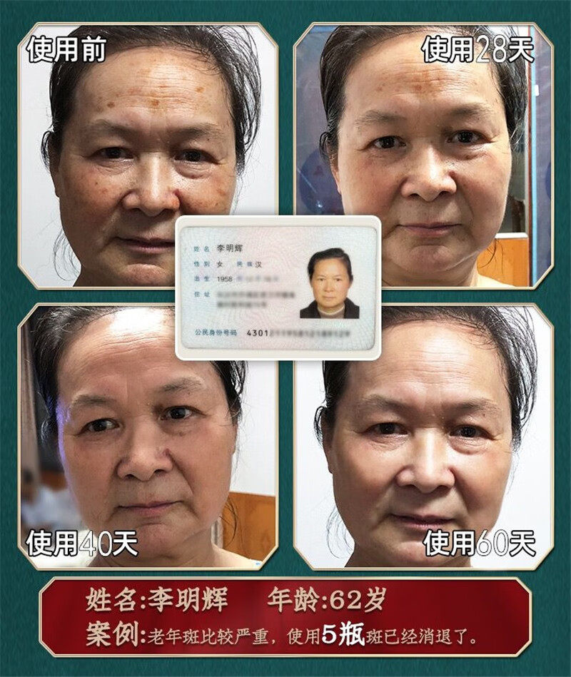 碧索娜（BISUONA）南京同仁堂美白祛斑霜去斑霜去雀斑老年斑晒斑黑斑黄褐斑妊娠斑淡化男女士面部祛斑产品30g