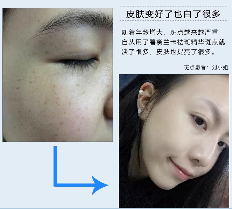 NHFOUYOU祛斑精华油点黑点玫瑰净颜精油补水美白提亮肤色溶斑精华美白淡斑 1瓶【体验装】