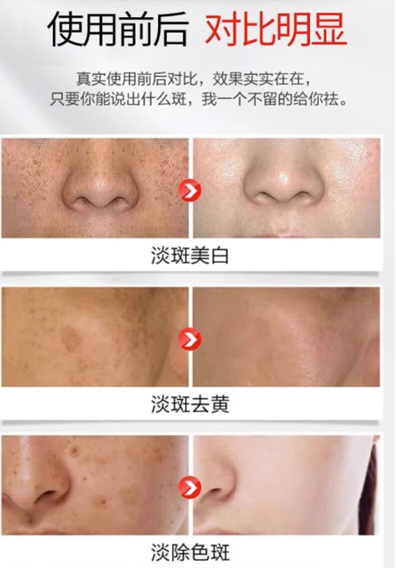 NHFOUYOU美白祛斑精华液淡化晒斑雀斑黄褐斑老年斑提亮肤色收缩毛孔 1瓶【体验装】