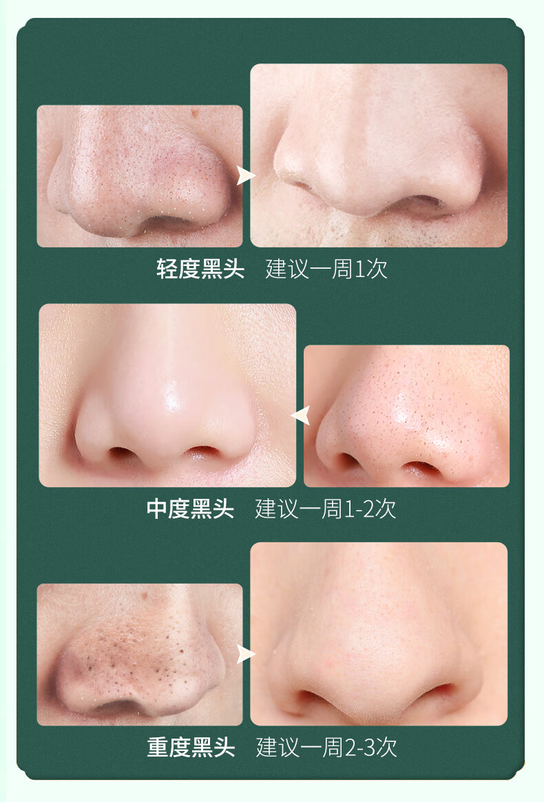 植物理想（zhiwulixiang）去黑头三件套保湿收敛清洁毛孔吸附黑头导出鼻贴男女通用T区护理 去黑头套盒【1盒装】