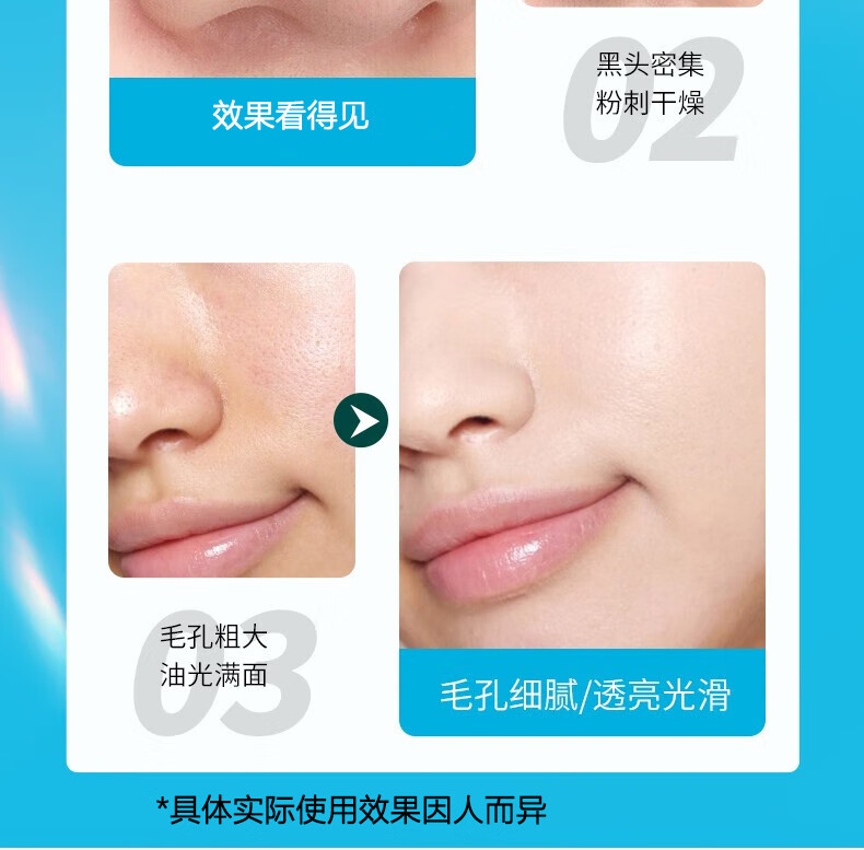 BAINHR祛痘淡印膏青春痘闭口粉刺祛痘不刺激男女生细致毛孔祛痘膏30g