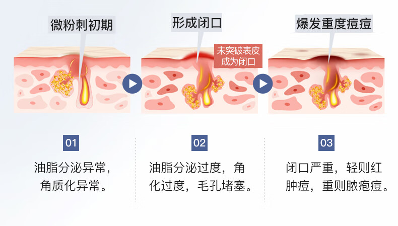 伊肤泉 清肤祛痘精华液30ml 水杨酸平闭口粉刺 控油 细致毛孔