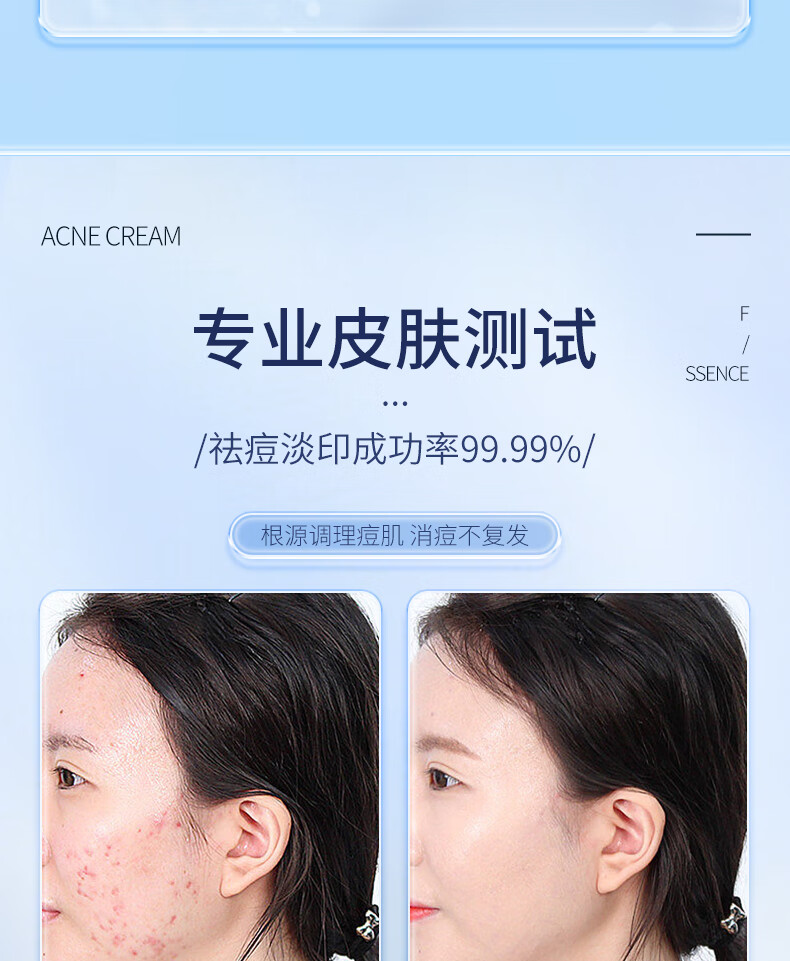 ORGINESE甘草植萃祛痘精华乳膏去闭口粉刺额头红肿痘痘姨妈痘下巴抗痘凝胶