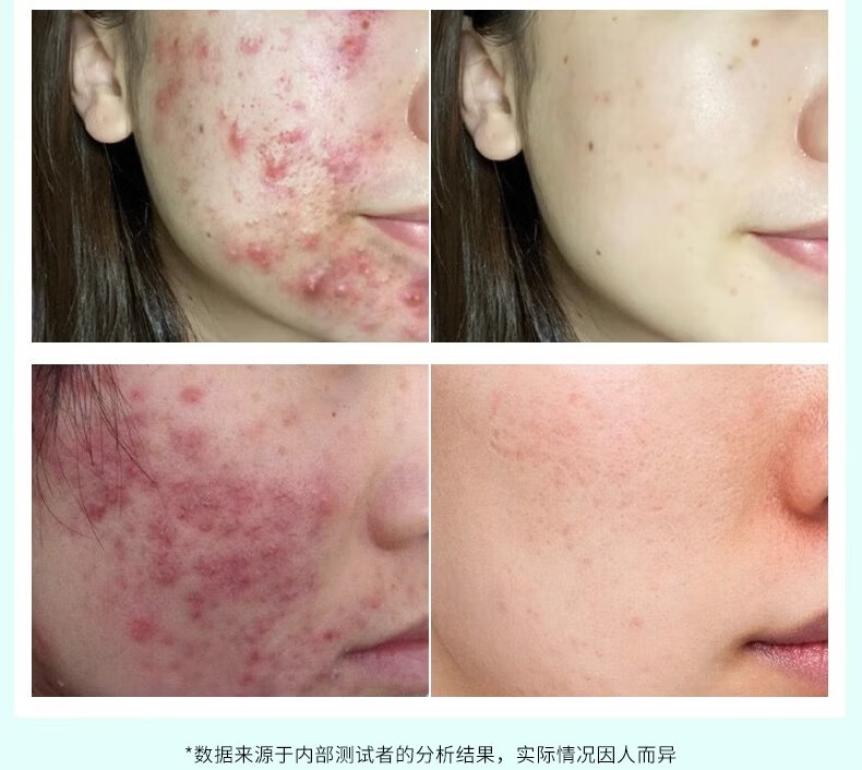 NHFOUYOU祛痘精华液修复淡化痘印痘坑青春痘祛痘疤闭口收缩毛孔油痘女男士 1瓶【体验装】30ml
