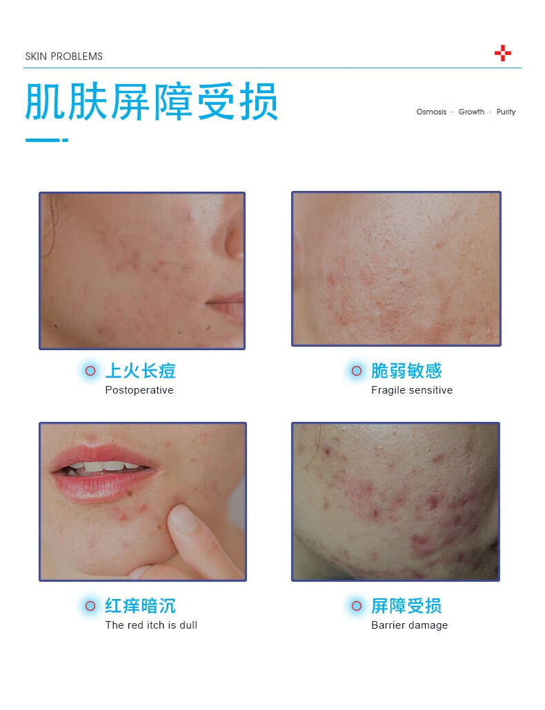 BAINHR祛痘淡印膏青春痘闭口粉刺祛痘不刺激男女生细致毛孔祛痘膏30g