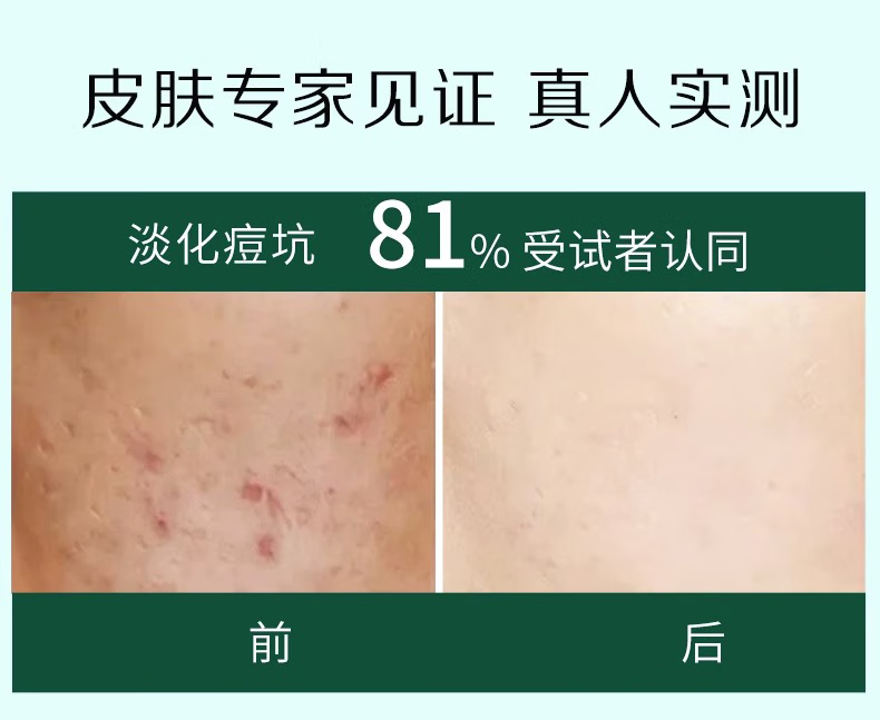 NHFOUYOU祛痘精华液修复淡化痘印痘坑青春痘祛痘疤闭口收缩毛孔油痘女男士 1瓶【体验装】30ml