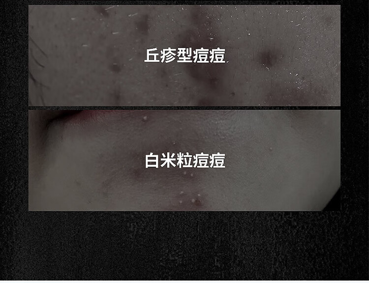 丁家宜男士寡肽精华原液淡化呵护痘印坑男女30ml去痘痘收缩毛孔补水精华
