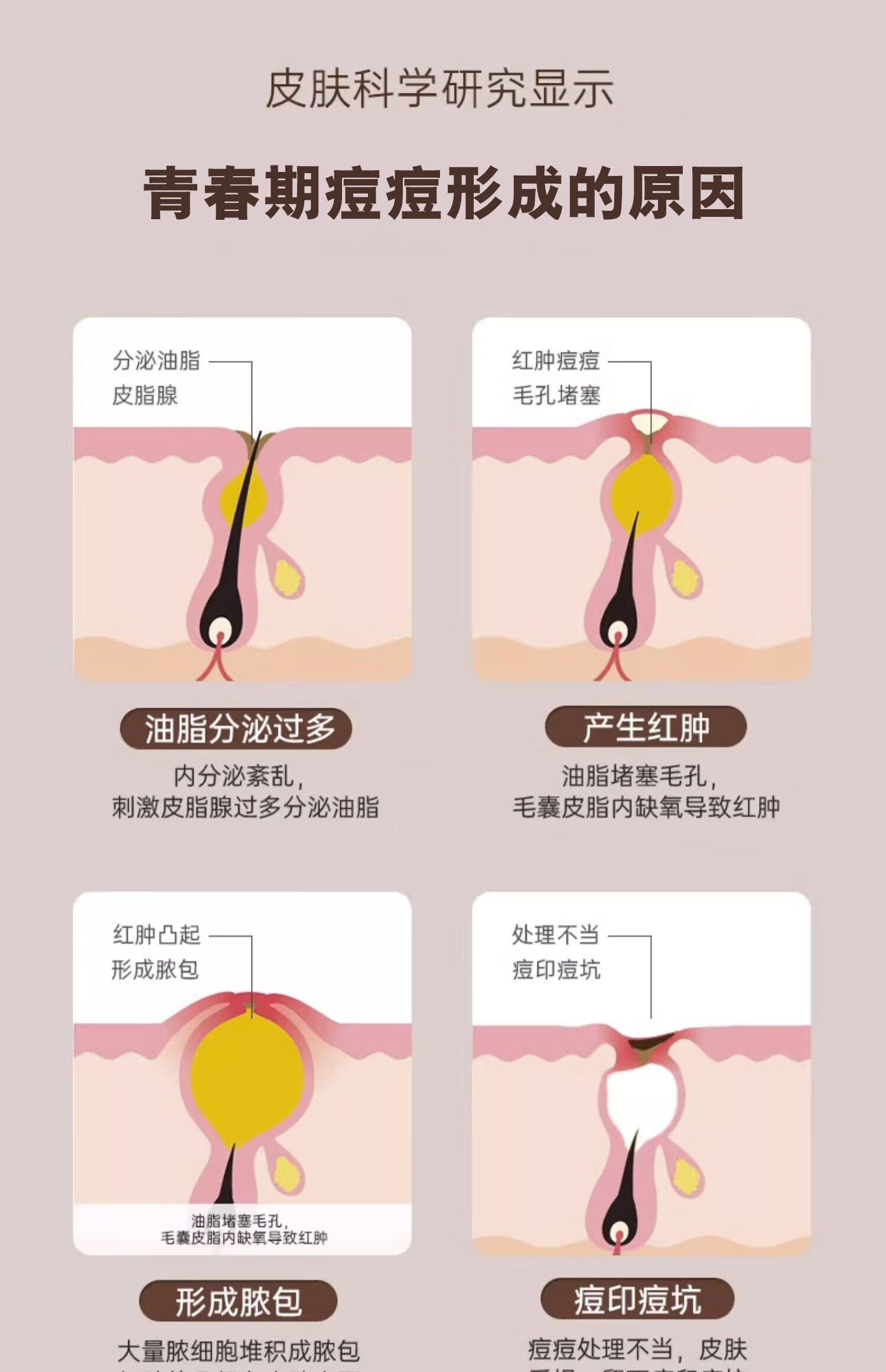 同仁堂祛痘药痘痘膏去痘痘和痘印男女初高中学生粉刺青春痘20g