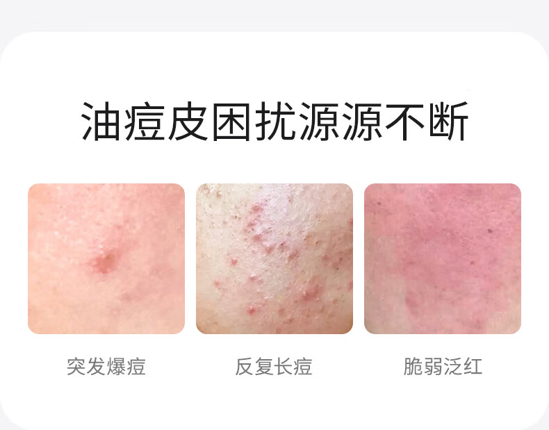美芙诺 20%高浓壬二酸祛痘乳改善痘肌控油去粉刺 淡化痘印 均匀肤色 15g【维稳防反复】