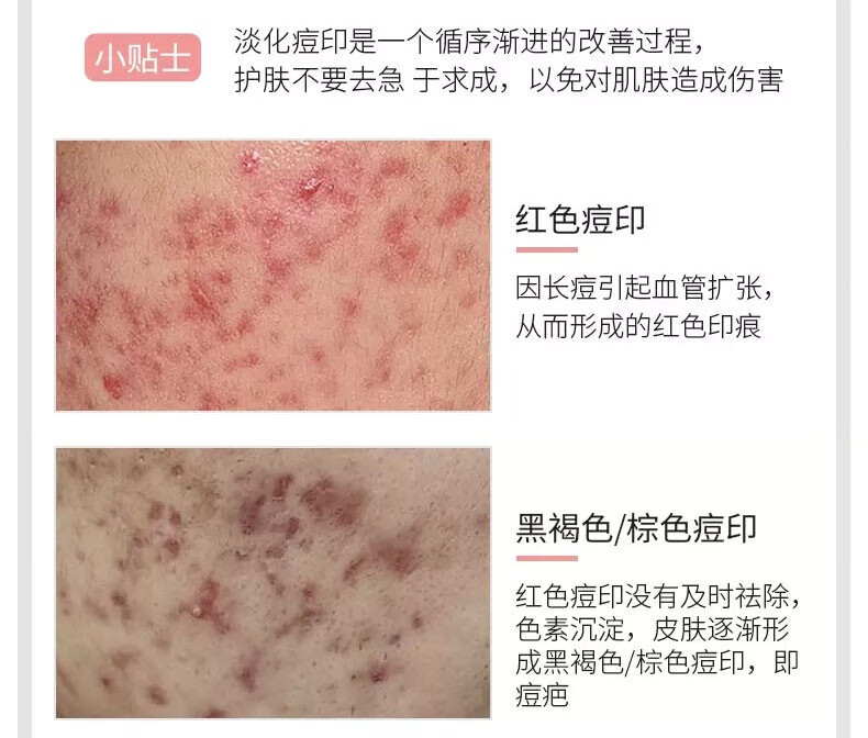 广药白云山祛痘膏痘印去痘疤痘坑呵护痘肌青春痘男女通用30g